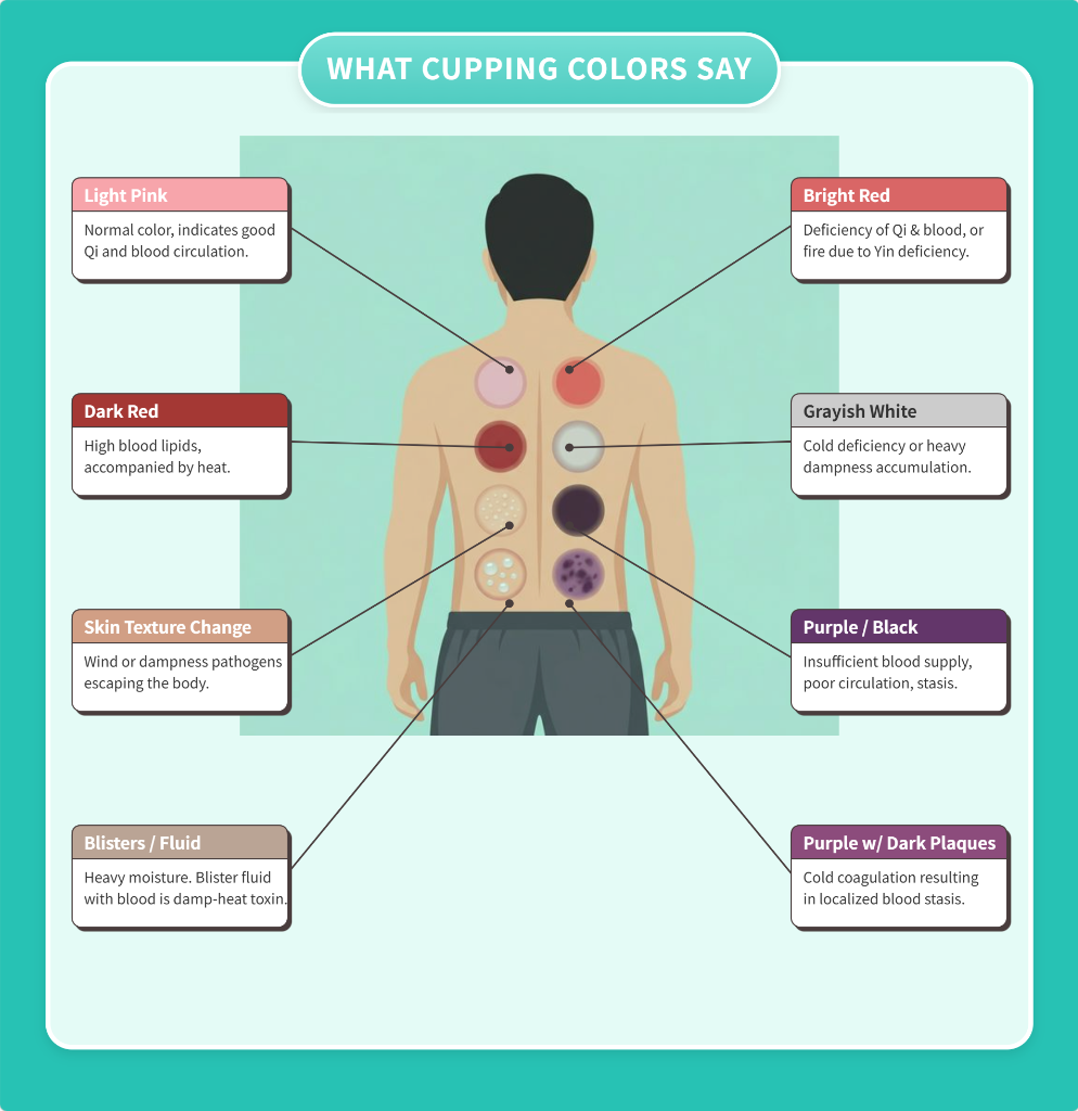 Cupping Color Chart infographic showing various skin marks and their TCM meanings