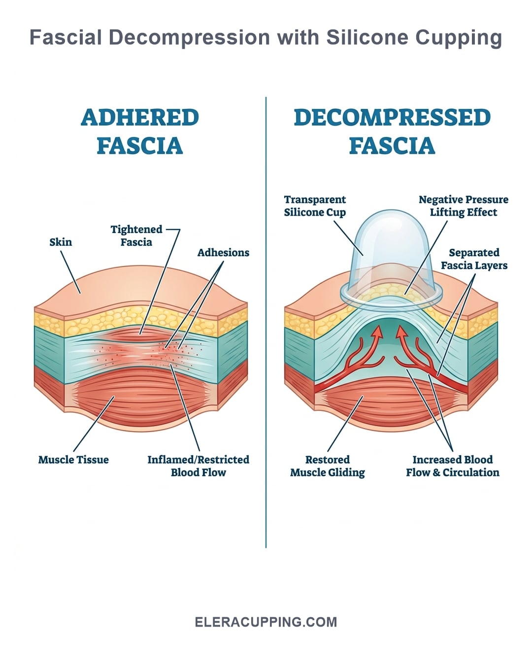 Anatomical infographic showing adhered vs decompressed fascia