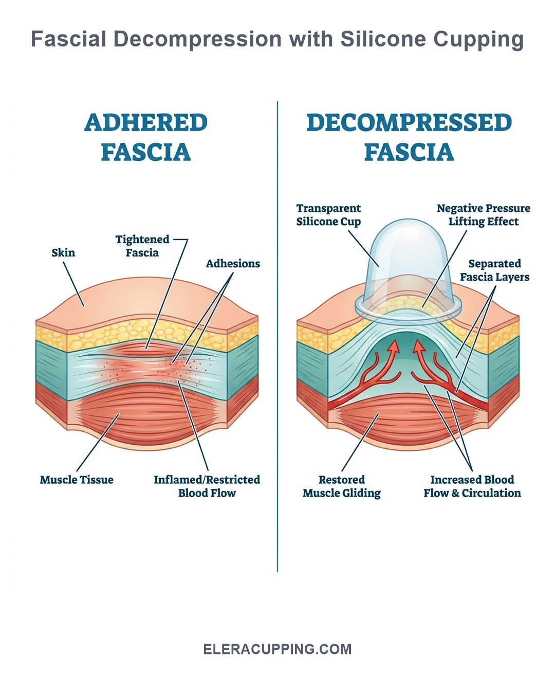 Anatomical infographic showing adhered vs decompressed fascia